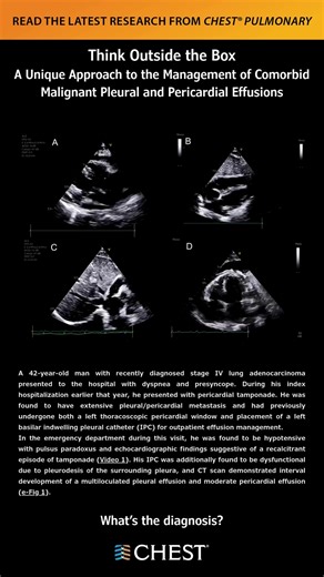 Think Outside the Box: A Unique Approach to the Management of Comorbid Malignant Pleural and Pericardial Effusions What's the diagnosis? Read the full article in the September issue of #journal_CHESTPulm: https://hubs.la/Q03JF9DM0 #MedEd #JournalCHEST | American College of Chest Physicians