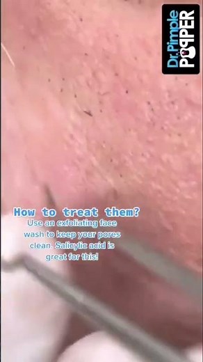 Sebaceous filaments and blackheads can look very similar, but they’re not the same thing🙅🏻‍♀️⁠