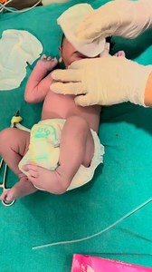 3.5K views · 69 reactions | After the birth of a new born baby, its umbilical cord is cut and separated. #newbornbaby #baby #nicubaby #babycare #prematurebaby | Anoop Gautam | Facebook