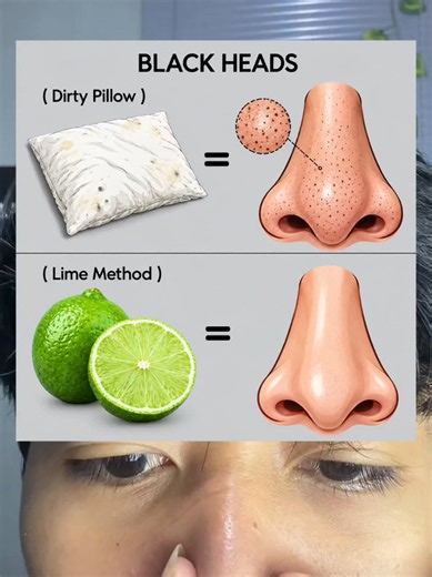 Lime Hack for Blackheads: See the Result of the Lemon Method