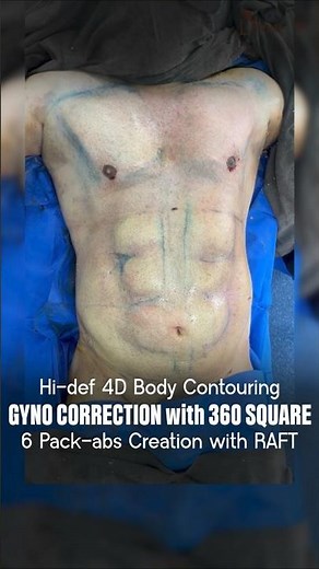 Hi-Def 4D Male Body Contouring | 6 Pack Abs Creation Before and After