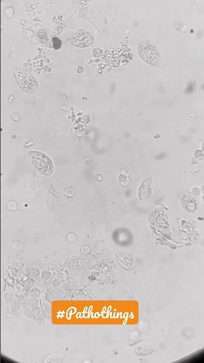#pathology #trichomonas motility in urine! #treat under microscope 🔬