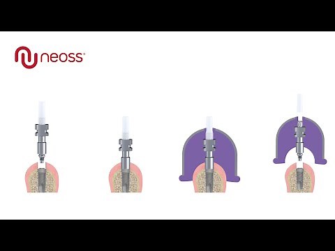 Neoss® Open Tray Impressions