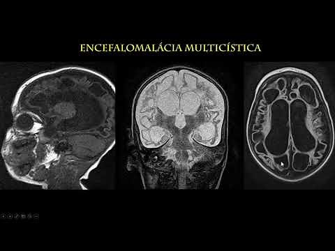 Encefalomalácia multicística