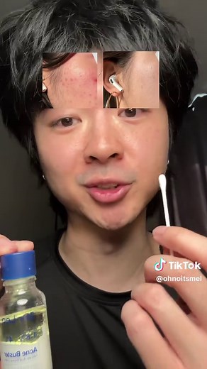 Understanding Cystic Acne and Effective Treatments