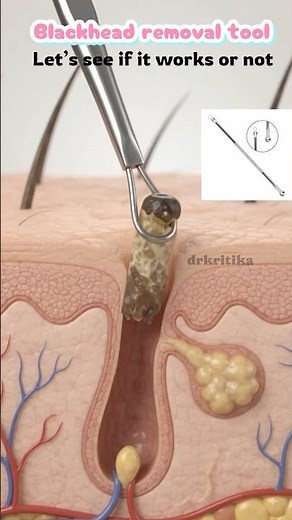 Blackhead removal Tool✨ #blackheads #blackheadremoval #drkritika #skincare #shorts #viral #skin