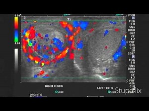 color Doppler ultrasound right orchitis