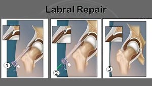 Labral Tears