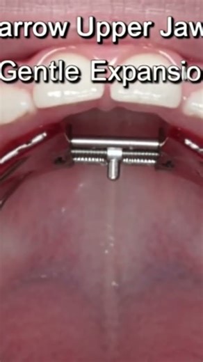 #ExpanderPlate #PalatalExpander #Orthodontics #JawExpansion #SmileCare #DentalReels