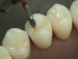 Class II Composite Preparation & Restoration • Video • MEDtube.net