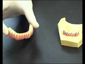 Pose prothèse amovible sur barre Ackerman