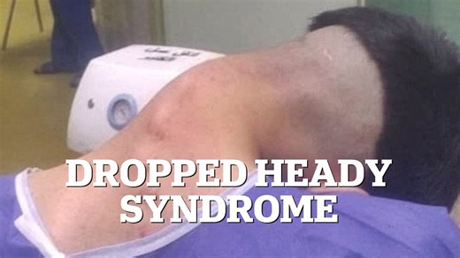 Man develops 'dropped head syndrome' after battling addiction