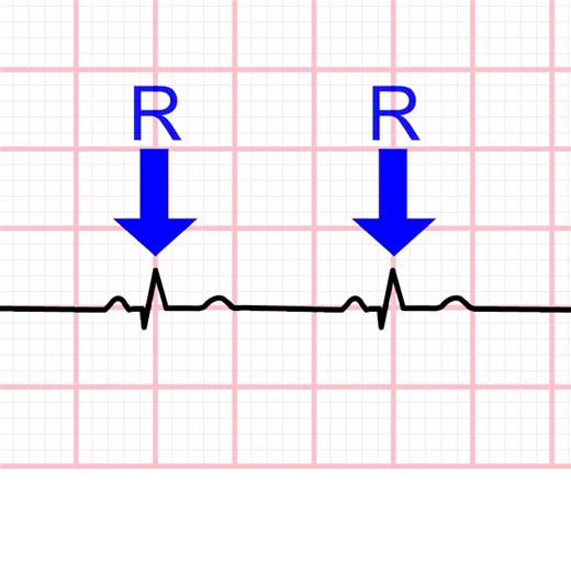 How to Calculate Heart-Rate from ECG - Learn more at https://acadoodle.com #emergencymedicine #intensivecare #respiratory #respiratorycare #icu #nurses #icunurse #ecg #ekg #cme #cmeonline | ECG Teacher