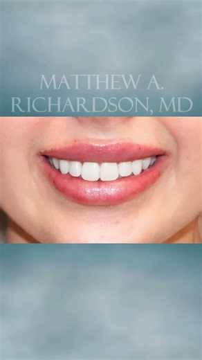 Before & immediately after one syringe of Volbella! 💉✨