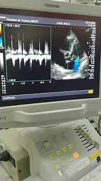Predictor de respuesta a Volumen por Ecocardiografia (Medición de VTI y elevación de MII)