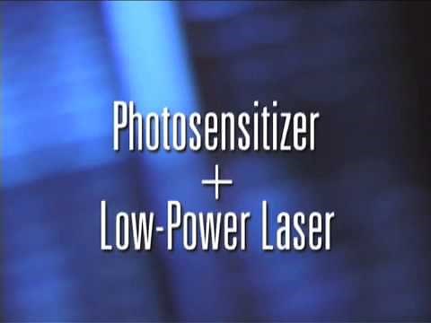 Photodynamic Therapy to Treat Macular Degeneration - Eye Associates