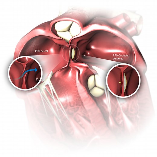 Heart Defect PFO - Occlutech - Every beat counts