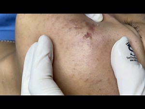 Inflammatory Acne P3 (Minh) | Mụn Viêm Tụ Máu P3 (Minh) - SacDepSpa#357