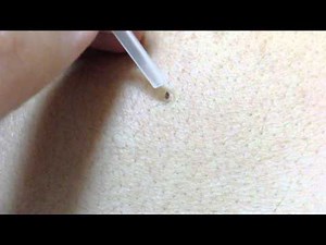 背中にできた角栓を取ります。4