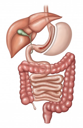 Sleeve Gastrectomy Surgery San Antonio | Sage Bariatric Institute