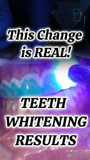 Teeth Whitening Really Works? Watch This Before & After Transformation!