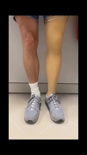 Foam Shaping Techniques for Above Knee Amputation