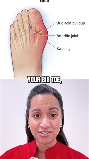 🚨 3 SIGNS YOUR FEET ARE TRYING TO WARN YOU — DON’T IGNORE THEM. 👣 Most people think foot problems are just… foot problems. But your feet can sometimes give you clues about what’s happening with the rest of your body. ⚠️ 1. Sudden swelling, redness & severe pain Especially in the big toe? It could be more than an ordinary “footache.” ⚠️ 2. Numbness, tingling or burning Don’t automatically blame your shoes. Changes in sensation deserve attention. ⚠️ 3. A wound that isn’t healing Especially if yo