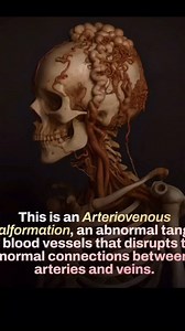 6.3K views | 易 What Is an AVM? (Arteriovenous Malformation) An AVM...