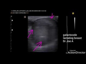 Galactocele lactating breast