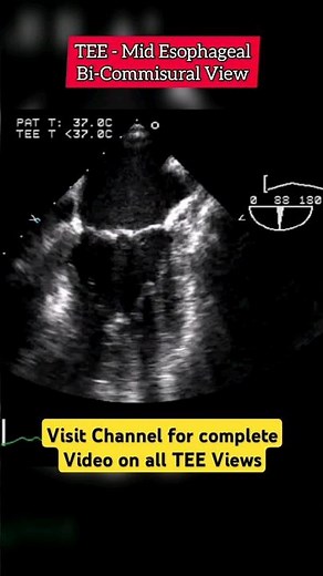 Mitral Comissural View on Transesophageal Echocardiogram #echocardiography #heart