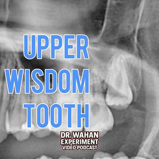 Upper Wisdom Tooth