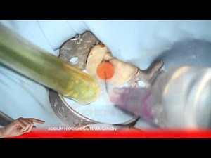 Endodontic treatment lower second molar - RECIPROC