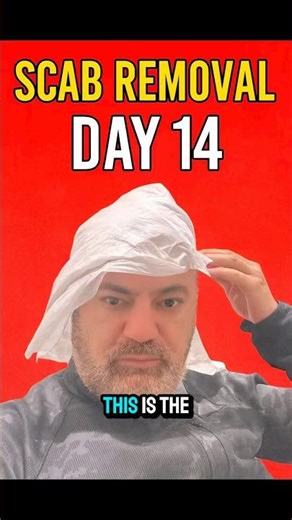 Day 14 Scab Removal… This Changes Everything! #hairtransplant #hairtransformation