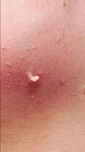 Who likes these chin cyst squeezes? 🙋🏻‍♀️ #drpimplepopper #popaholics