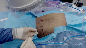 Endoscopic Approach to Thoracic Discectomy