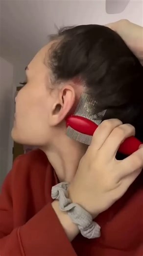 OMG Lice_Comb ✅ #Shorts #trending #shortsfeed #viral #lice #support #subscribe #licecomb