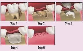 Holistic Bone Graft Techniques using Biological PRF