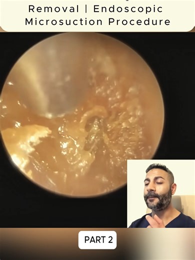 1,670 - Scuba Diving Ear Wax Removal Endoscopic Microsuction Procedure (2)#scuba #removal #wax