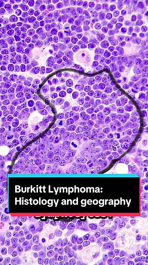 Two pathologists then began to study #burkittlymphoma under the microscope. It had a starry sky appearance. The dark blue sky was made up of round, blue cells – these are the malignant lymphocytes. The emptier areas, or the stars, contained large cells called macrophages that chewed up cellular debris from the very rapidly dividing lymphocytes. Next, Dr. Burkitt would track the incidence of Burkitt lymphoma after a colleague told him he had never seen a case in South Africa. The geographic distr