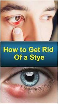 How to Treat a Stye Naturally || Stye Treatment || Smartvision Eye Hospitals #shorts #stye #eyecare