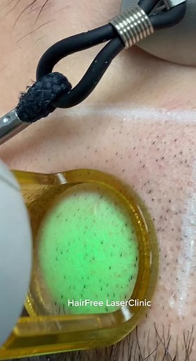 #laser #skincare #skin #fyp #voorjou #hairremoval #foryoupage #foryou #nohair #beauty #fypシ #love #salon #satisfying #asmr #fy #men #beard #fy #laser