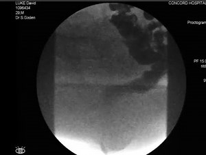 Defecography, or evacuation proctography