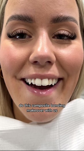 Dr Danya Composite Bonding Transformation on 7 Upper Teeth