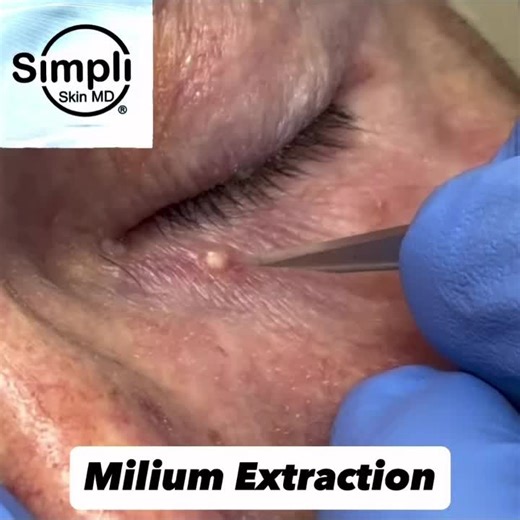 Happy Friday! This Milium gets extracted and says bye bye! Music Credit: Michael Jackson - Smooth Criminal #milia #milium #blackhead #extraction #pimple