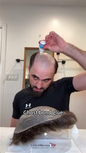 He Glued WHAT To His Head? #hairlosstreatment #hairreplacement