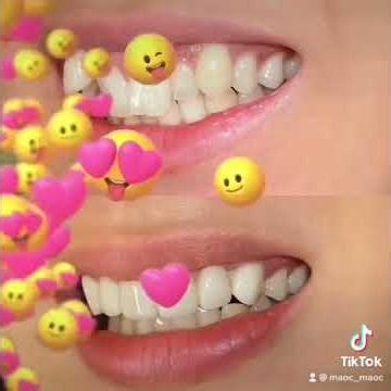 #ガミースマイル #セラミック矯正 #削らないラミネートベニア #削らないセラミック #歯肉整形