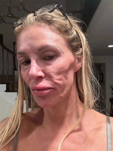 Brandi Glanville debuts new look after struggling with 'face parasite'