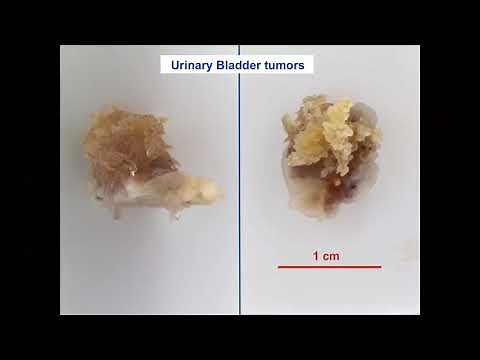 EN bloc resection of bladder tumor Dr Jeremy Teoh