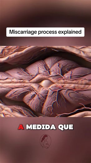 Understanding the Miscarriage Process