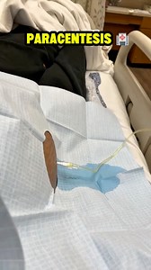 675K views · 4.3K reactions | Paracentesis ‍⚕️ #viralreelsシ | Elenfermerocesar | Facebook